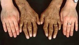 Lh&eacute;mochromatose