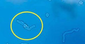 La myod&eacute;sopsie 