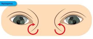 Nystagmus