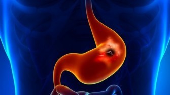 Cancer de lestomac avant 40 ans en Europe : des caract&eacute;ristiques propres ?