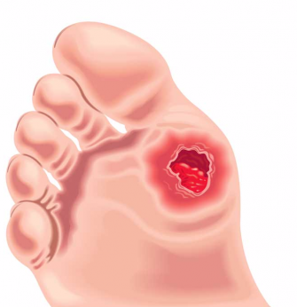 Pied diab&eacute;tique