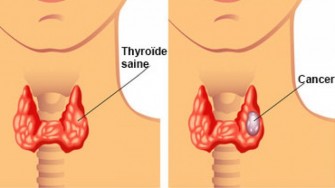 Quelle imagerie recommander dans la recherche de m&eacute;tastases dans le cancer m&eacute;dullaire de la thyro&iuml;de