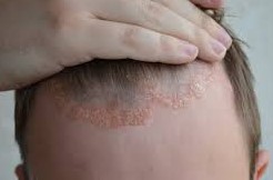 Se d&eacute;barrasser de la dermite s&eacute;borrh&eacute;ique 