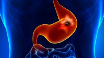 Risques de suites compliqu&eacute;es apr&egrave;s intervention pour ulc&egrave;re gastro-duod&eacute;nal perfor&eacute;