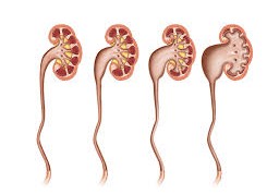 Lhydron&eacute;phrose