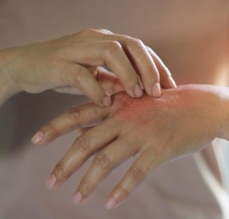 Pr&eacute;venir les dartres