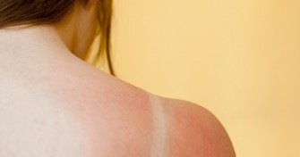 Ne commettre  ces choses apr&egrave;s un coup de soleil