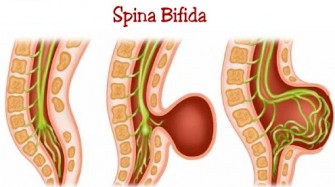 Spina bifida 