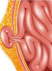 Les &eacute;ventrations