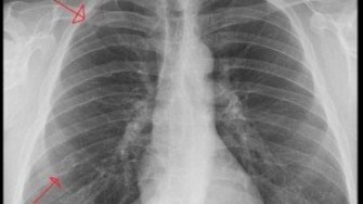 Les fractures de cote chez l&acute;homme &acirc;g&eacute; sont un signe d&acute;ost&eacute;oporose