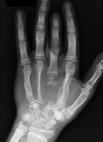 Maladie de Gorham-Stout: syndrome de los fant&ocirc;me