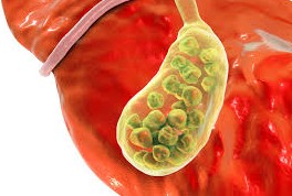 Pr&eacute;venir les calculs biliaires