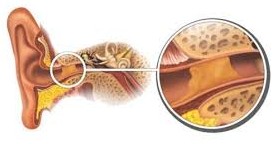 Bouchon d&rsquo;oreille 