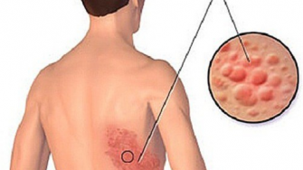  Le zona et l&rsquo;herp&egrave;s 