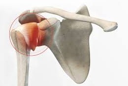 La capsulite r&eacute;tractile 