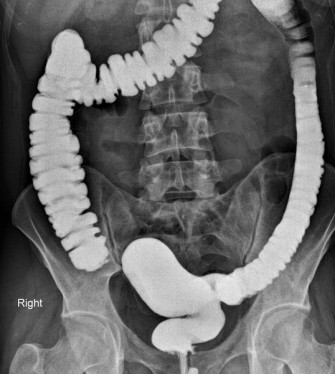 Le dolichoc&ocirc;lon