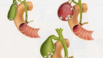 Comment aborder chirurgicalement les chol&eacute;cystites aigu&euml;s ?