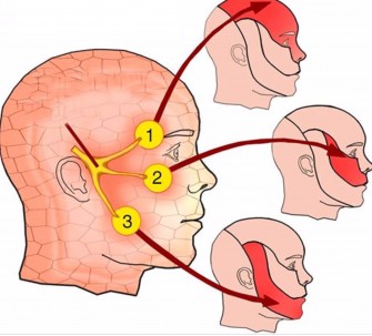 La n&eacute;vralgie du trijumeau 