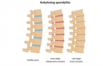 Spondylarthrite ankylosante