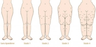 Lip&oelig;d&egrave;me