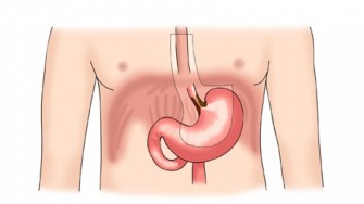 Un cancer oesogastrique avec une lame dascite &agrave; l&eacute;choendoscopie est le plus souvent inop&eacute;rable