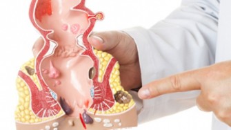 Quelle qualit&eacute; de vie apr&egrave;s gu&eacute;rison d&rsquo;une fistule digestive &agrave; la peau ?