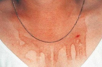 L&rsquo;h&eacute;matidrose