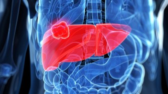 Tumeurs du foie et radiofr&eacute;quence