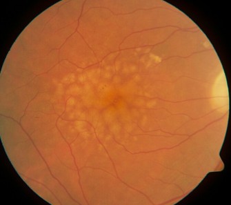  La d&eacute;g&eacute;n&eacute;rescence maculaire li&eacute;e &agrave; l&rsquo;&acirc;ge (DMLA)
