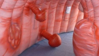 Chip pour carcinose p&eacute;riton&eacute;ale d&rsquo;origine colorectale : Quel int&eacute;r&ecirc;t et pour quels patients ? R&eacute;sultats d&rsquo;une large s&eacute;rie multicentrique internationale