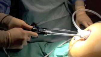 La cholangiographie perop&eacute;ratoire (CPO) syst&eacute;matique