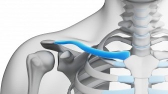 Fracture de clavicule : &eacute;tat de l&rsquo;art