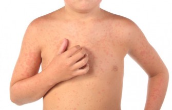 Campagne nationale de vaccination contre la rougeole et la rub&eacute;ole