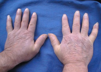 La Scl&eacute;rodermie