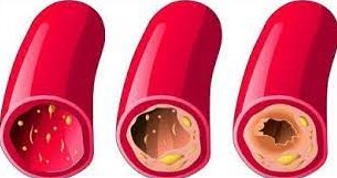 Aliments qui d&eacute;bouchent les art&egrave;res