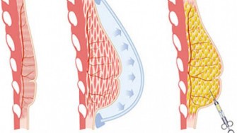 Reconstruction mammaire et injection de graisse : quel risque pour le sein ?