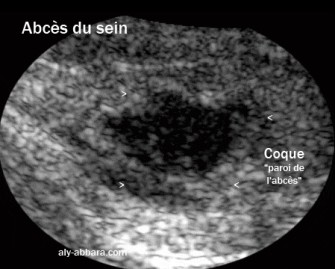 Abc&egrave;s mammaire