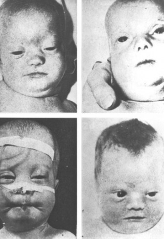 Syndrome de Zellweger