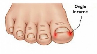  L&rsquo;ongle incarn&eacute;