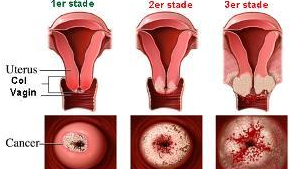 Le d&eacute;pistage et la pr&eacute;vention du cancer du col
