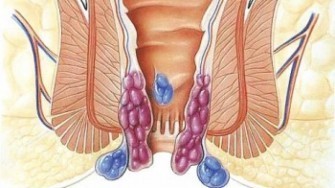 Cancer du canal anal : plus c&rsquo;est long, moins  c&rsquo;est bon !