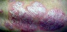 psoriasis